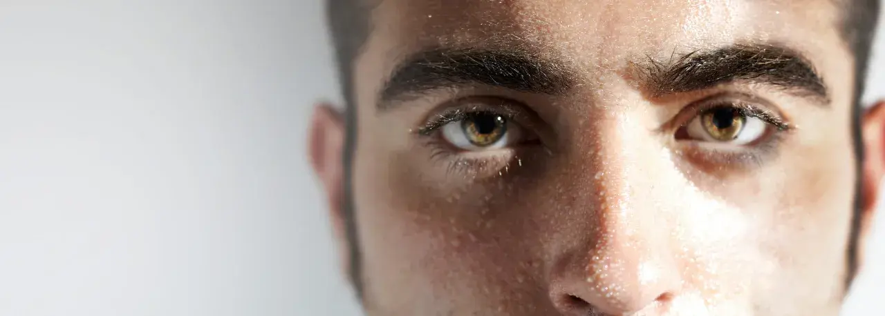 Ojos y frente de un hombre con gotas de sudor visibles, evidencia de hiperhidrosis facial.