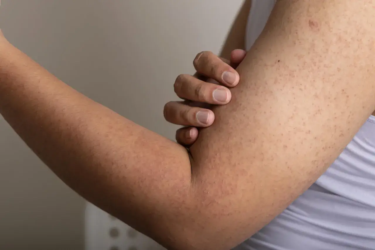 Brazo con peque&ntilde;os bultos rojos y &aacute;speros, caracter&iacute;sticos de la queratosis pilaris.