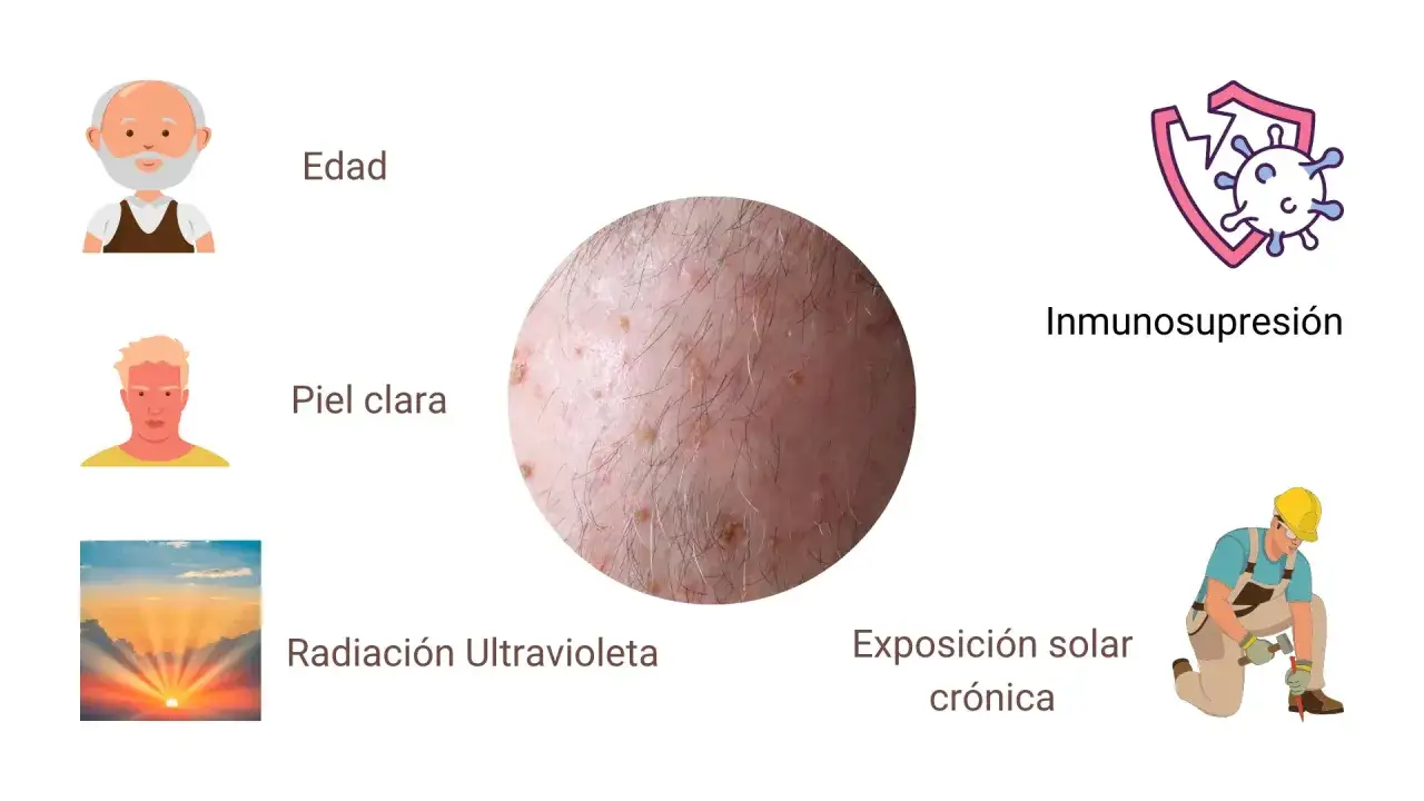 Primer plano de una cabeza con queratosis solar, rodeada de iconos que representan edad, piel clara, radiación UV, inmunosupresión y exposición solar crónica.