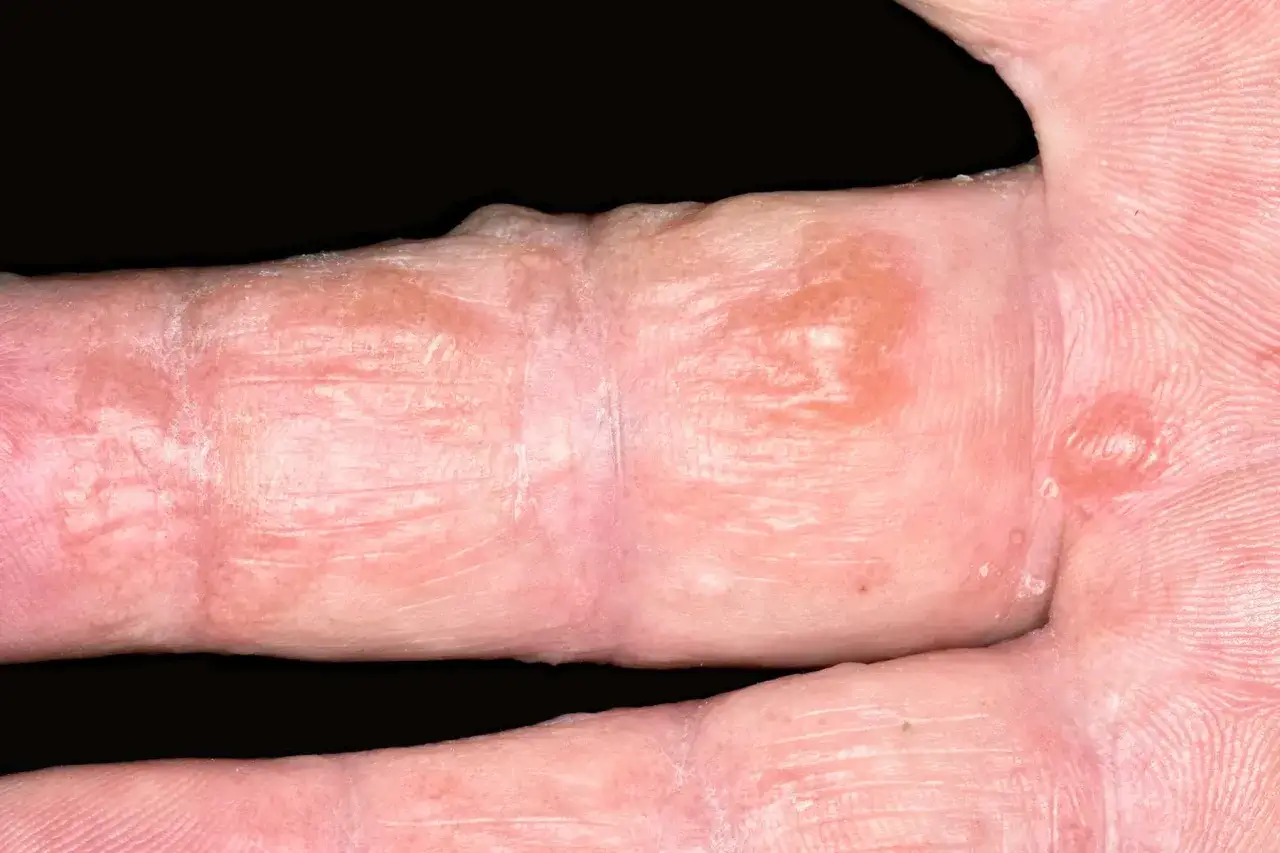 Dedos con ampollas y piel enrojecida, indicativo de dishidrosis mano.