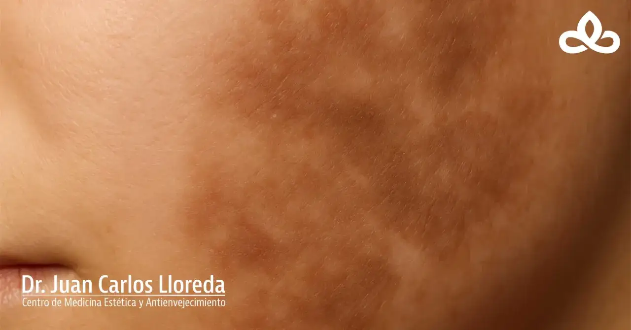 Piel con hiperpigmentaci&oacute;n postinflamatoria, mostrando manchas oscuras y textura irregular. Logo de Dr. Juan Carlos Lloreda.