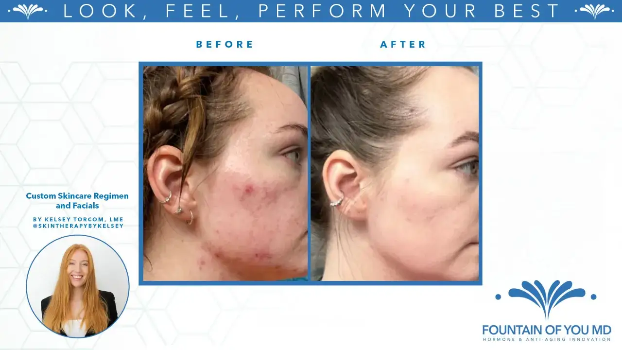 Antes y después de un tratamiento facial. Muestra cómo un grano puede ser peligroso si no se trata adecuadamente.