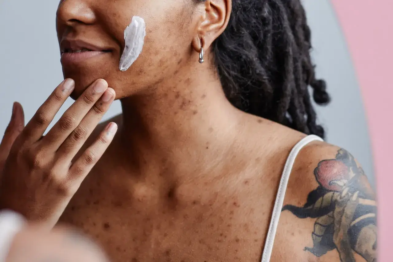 Una persona se aplica crema hidratante en la cara, mostrando que es bueno echarse crema hidratante en los granos para cuidarlos.