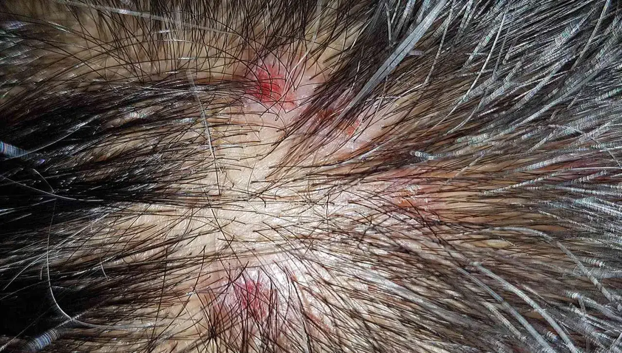 Primer plano del cuero cabelludo con inflamaci&oacute;n y enrojecimiento, indicativo de foliculitis.