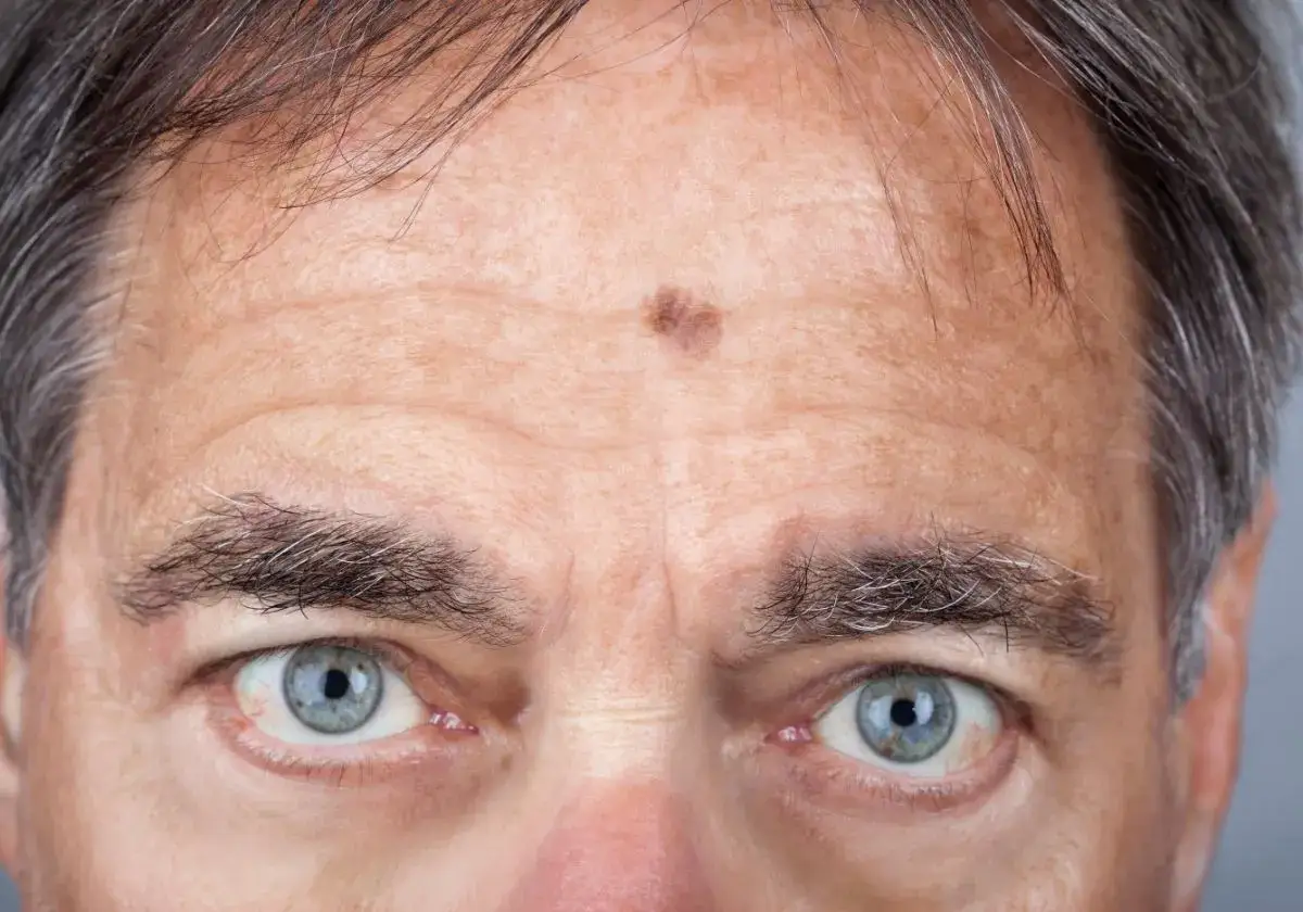 Primer plano de la frente de un hombre con arrugas y una mancha oscura, signos de fotoenvejecimiento por el sol.