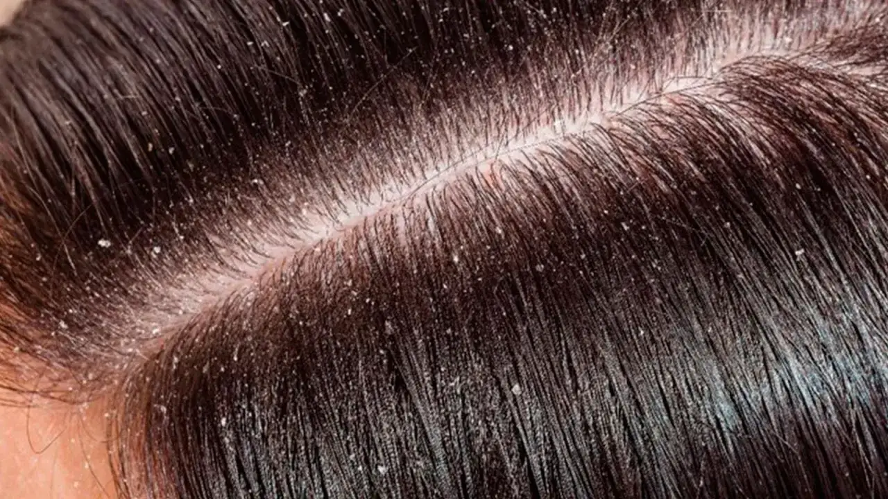 Primer plano del cuero cabelludo con cabello oscuro y escamas blancas, indicando varios tipos de caspa en la cabeza.