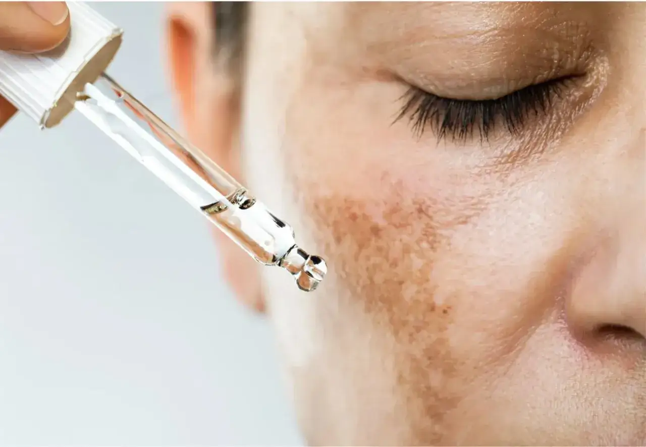 Gotas de suero sobre piel con manchas, quizás para tratar la melanina que es.