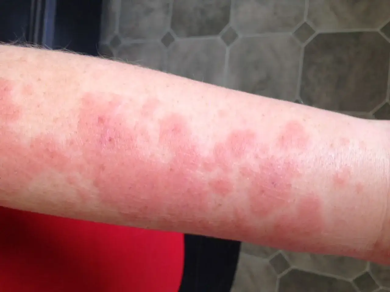 Brazo con erupci&oacute;n roja y elevada, indicando una posible reaccion alergica al sol.