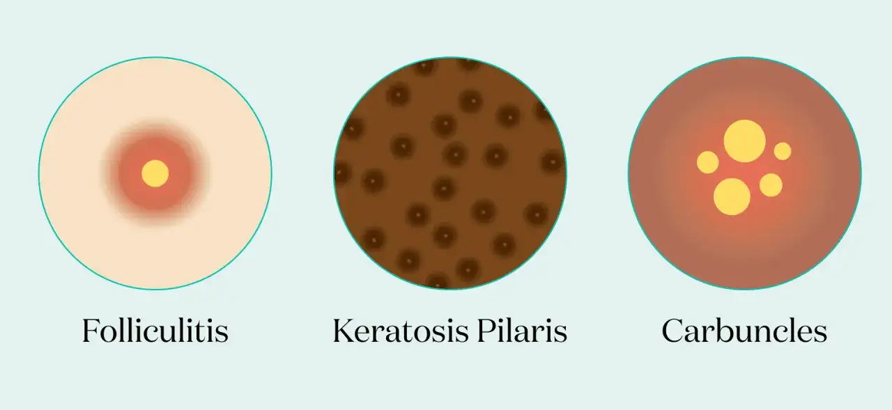 Ilustraci&oacute;n de foliculitis, queratosis pilaris y carbuncos. Podr&iacute;an ser granos en el culo.