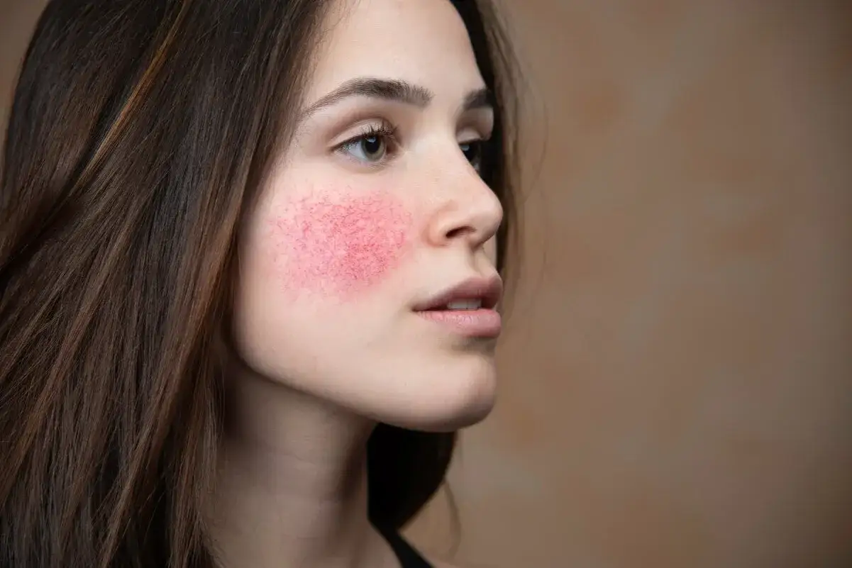 Mujer con rubor facial, mostrando enrojecimiento y pequeños vasos sanguíneos en la mejilla.