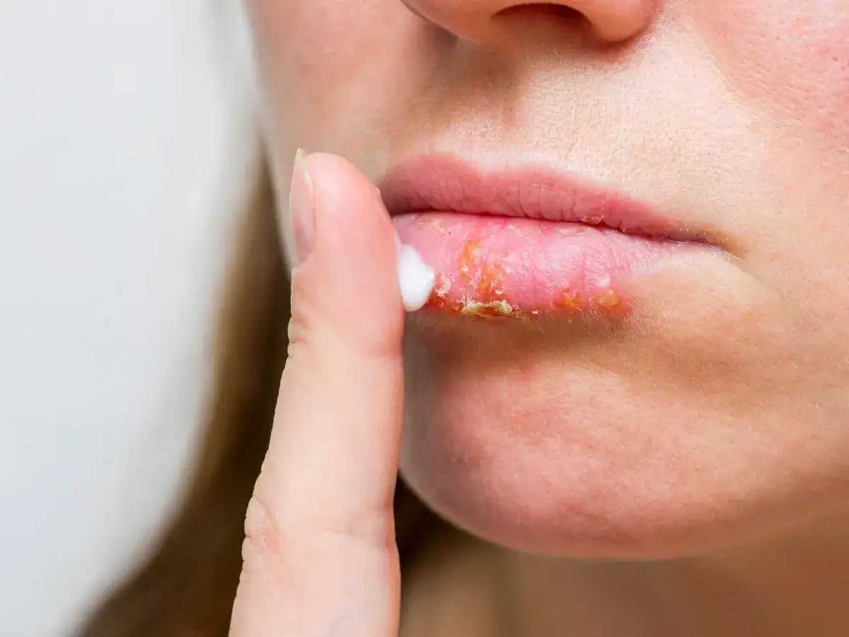 Dedo aplica crema en labios agrietados y con costras, posiblemente por labios quemados por el sol.