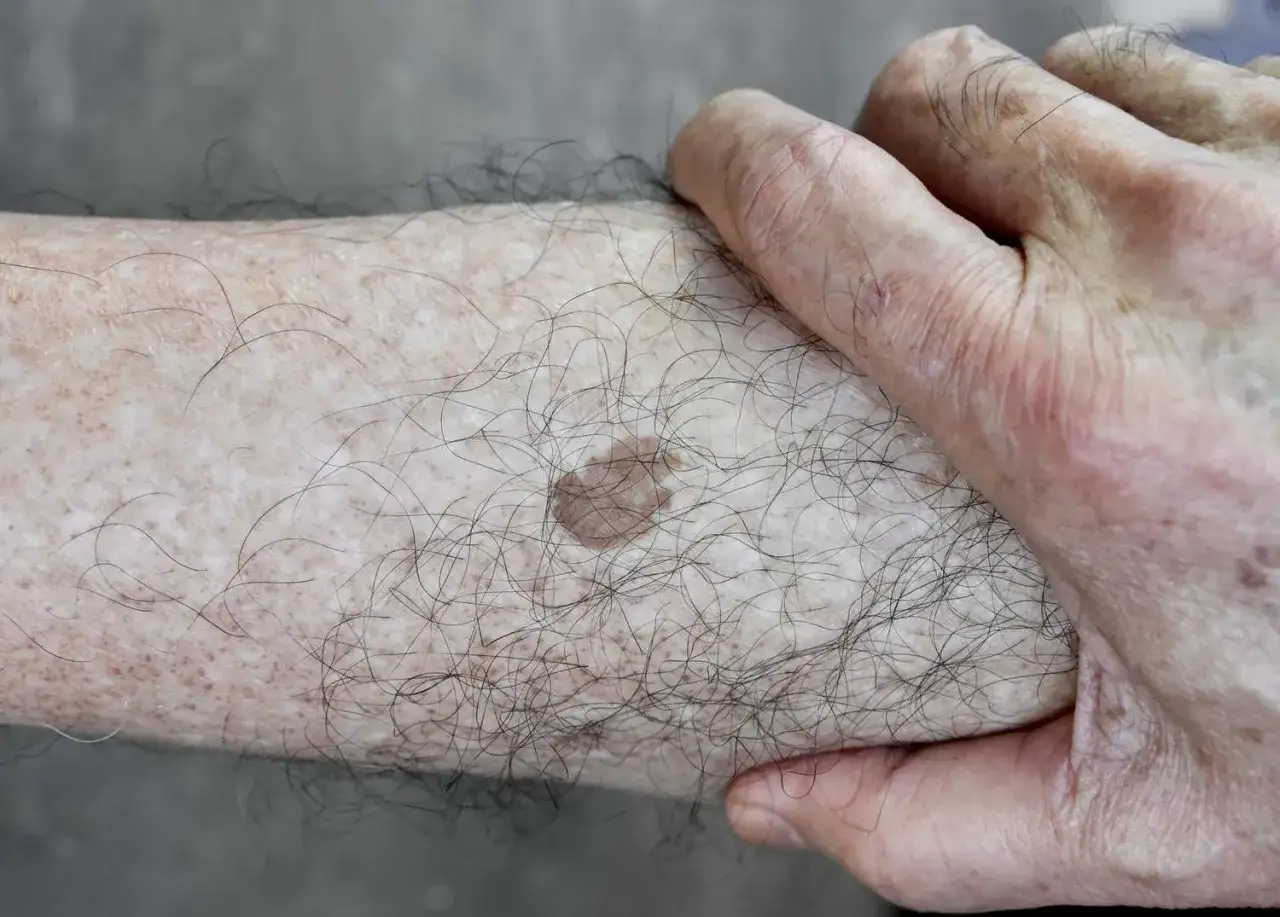 Primer plano de una pierna con varios tipos de manchas, incluyendo una mancha marrón más oscura y pecas.
