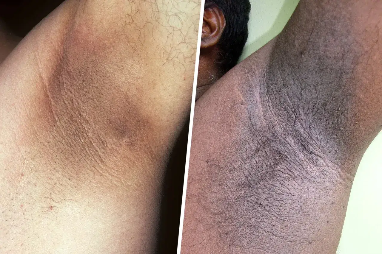 Comparaci&oacute;n de axilas: antes y despu&eacute;s del acantosis nigricans tratamiento. Piel oscura y engrosada en la axila.