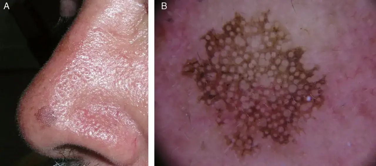 Imagen A: Nariz con lesión sospechosa de queratosis actínica. Imagen B: Dermatoscopia de la lesión, mostrando patrones irregulares.