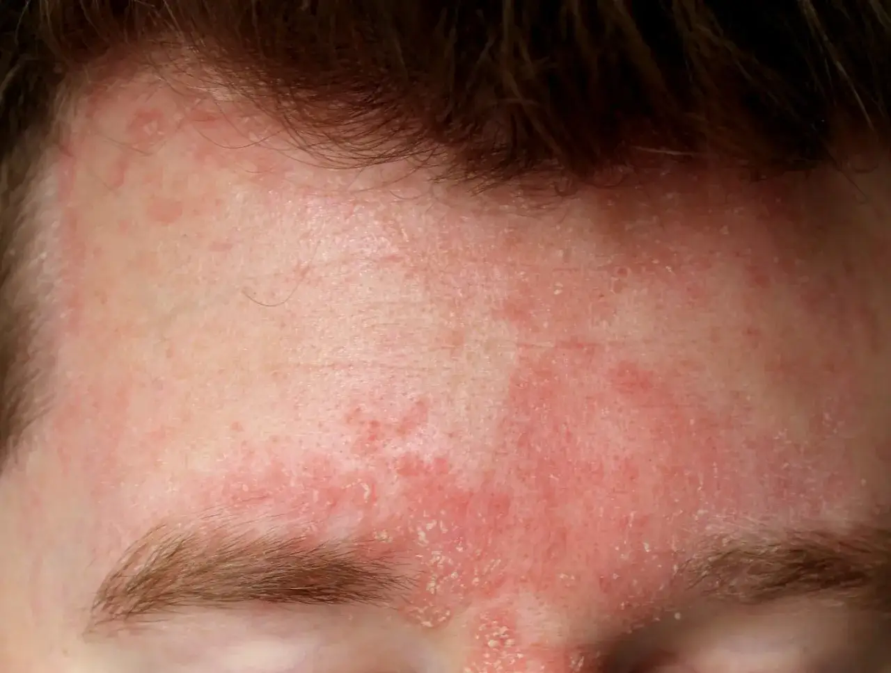 Frente enrojecida y descamada, indicativa de dermatitis seborreica. El tratamiento es clave para aliviar estos síntomas.