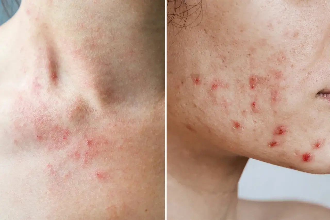Piel con granitos rojos y peque&ntilde;os bultos, indicando una posible reacci&oacute;n al&eacute;rgica en el cuello y mejilla.