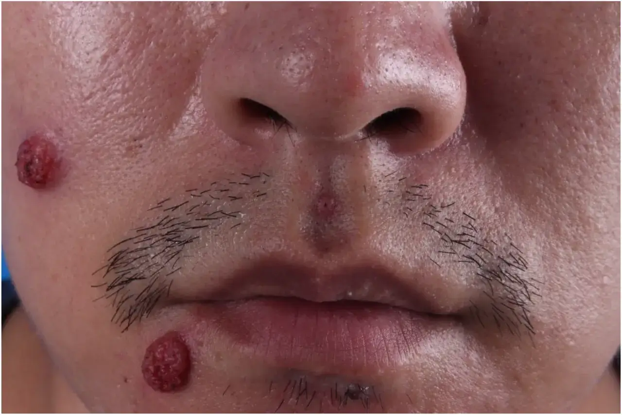 Una mancha abultada en la cara de color rojizo, con textura rugosa, aparece en la mejilla izquierda y cerca del labio inferior.